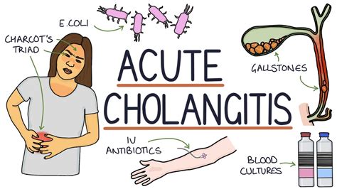 Understanding Acute Cholangitis Ascending Cholangitis Youtube