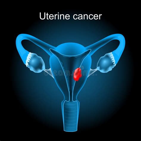 Uterine Cancer Cross Section Of A Human Uterus With Endometrial Tumor