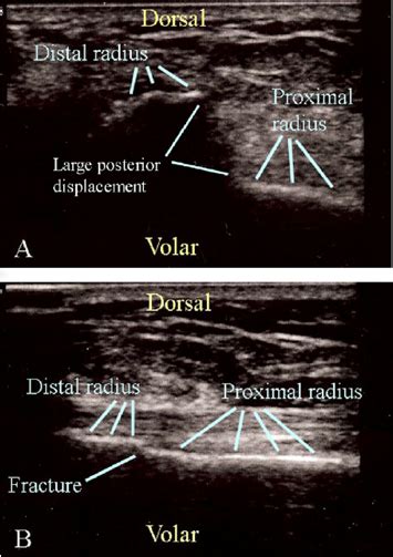 Ultrasound In Pediatric Distal Forearm Fractures Nuem Blog