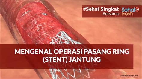 Mengenal Operasi Pasang Ring Stent Jantung Credit For Sehatfresh