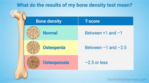 Slide Show Screening And Diagnosing Bone Health And Osteoporosis