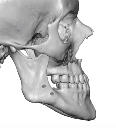 Plastic Surgery Case Study Custom Midface Implant For Total Midface