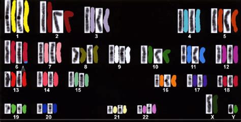 Chromosome Analysis Of The Patient Using Spectral Karyotyping SKY