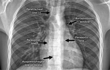 Chest Medicine Made Easy Dr Deepu Basics Of Chest X Ray Part The