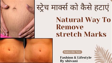 How To Remove Stretch Marks Naturally स्ट्रेच मार्क्स को कैसे हटाएं