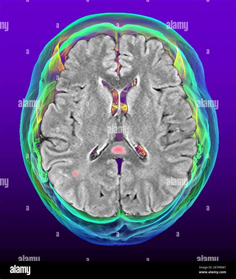 Coloured 2D Magnetic Resonance Imaging MRI And 3D Computed Tomography