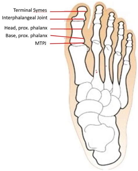 Long Term Outcomes Of Hallux Amputations At Various Anatomic Levels