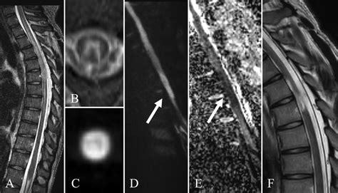 Thoracic Spinal Cord Injury After Surgical Removal Of A Ruptured