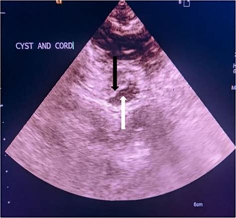 Arachnoid Cyst Ultrasound