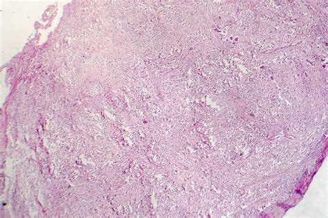 Foreign Body Granuloma Stock Image Image Of Microphotograph 122936289