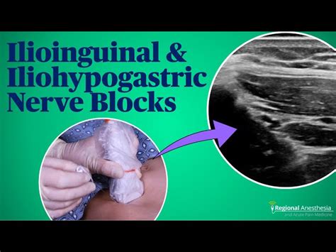 Iliohypogastric Nerve Block