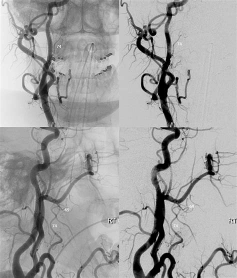 Ascending Palatine Artery Neuroangio Org