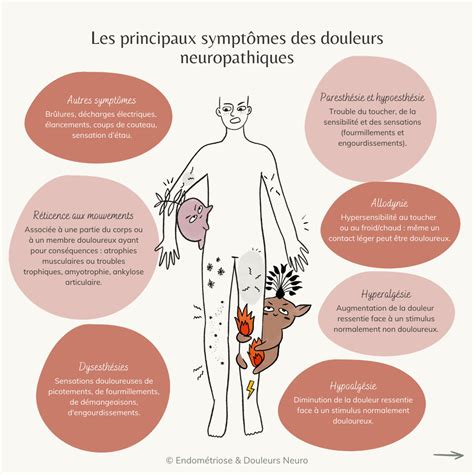 Douleurs neuropathiques nociceptives Association Endométriose