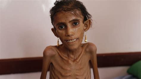 Emaciated Face