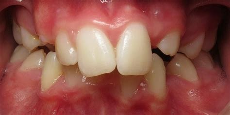 Overjet Vs Overbite