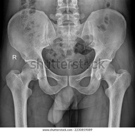 Normal Pelvis X Ray