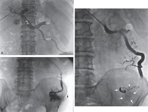 A Percutaneous Transhepatic Portal Venography Revealed Widened Portal