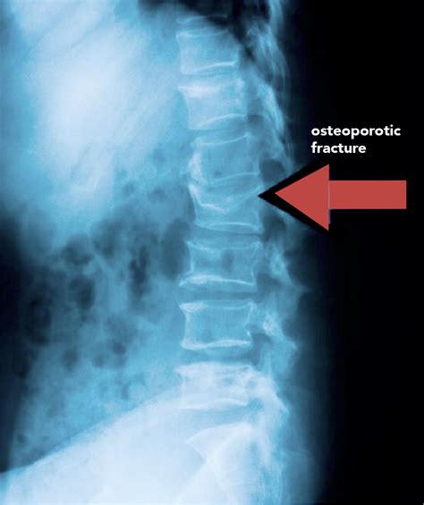 Vertebral Compression Osteoporotic Fractures Rajiv Bajekal