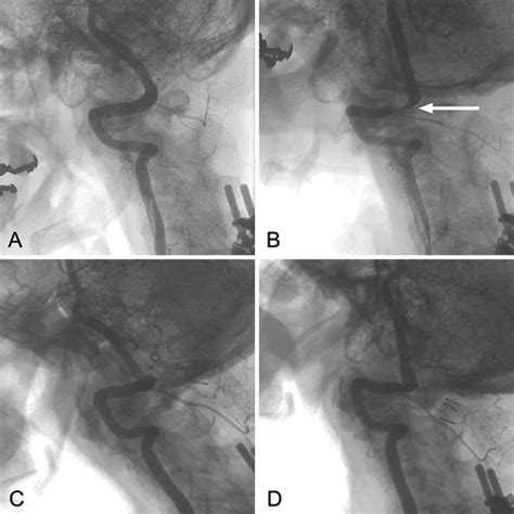 Four Vessel Cerebral DSA Lateral View A Right ICA Injection