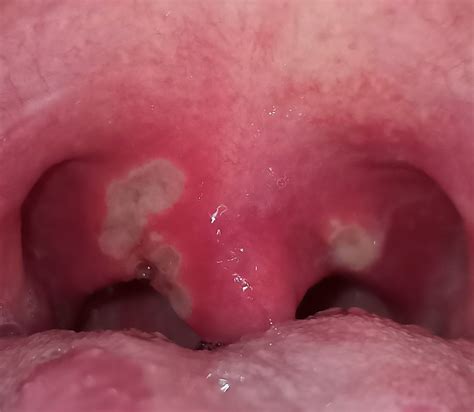 Top 92 Pictures Photos Of Canker Sores On Tongue Superb