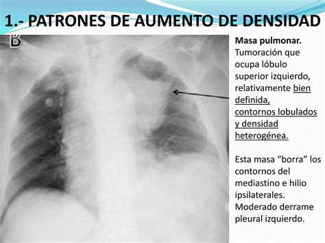 Principales Patrones Radiológicos En La Placa Simple De Tórax Ppt