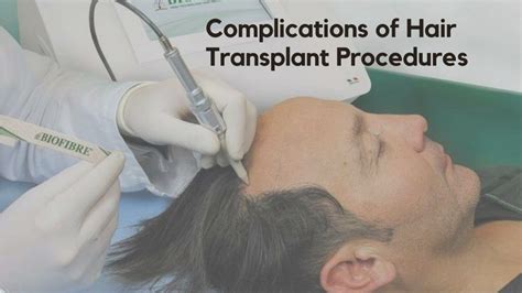 Ppt Complications Of Hair Transplant Procedures Powerpoint Presentation Id 12643853