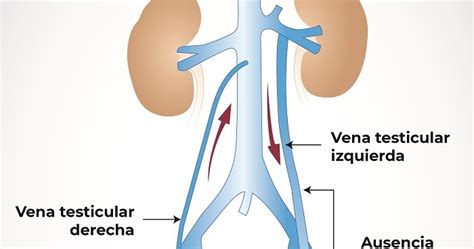 Varicocele Testicular La Causa Más Común De Infertilidad Masculina