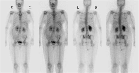 Radiology Teaching File Nm Bone Case 309347