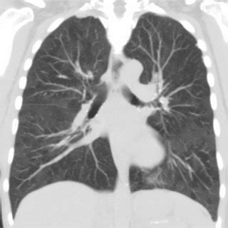 Axial Images From A Ct Chest Shown Here In Both Inspiration And