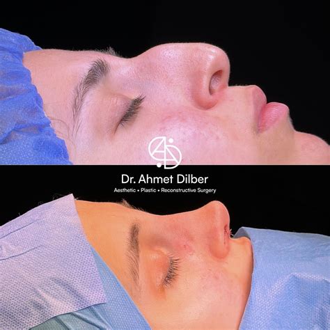 Rhinoplasty Result Dr Ahmet Dilber Rhinoplasty Plastic Surgery