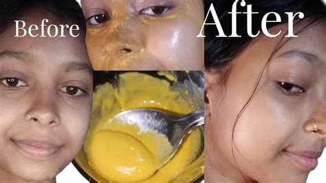 Besan Face Pack To Clear Spotless And Glowing Skin Gram Flour Face Pack