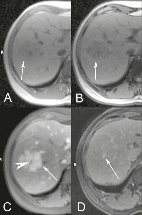 Scielo Brasil Fat Containing Liver Lesions A Pictorial Review Fat