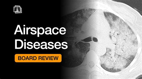 Airspace Diseases Chest Radiology Board Review YouTube