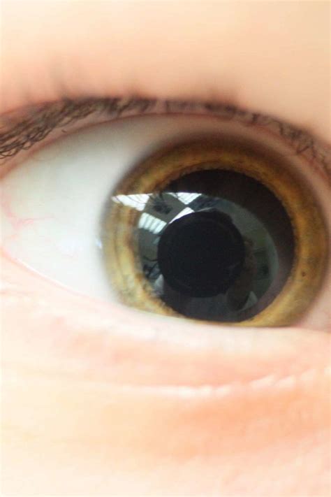 Mydriasis Causes And Treatment For Dilated Pupils