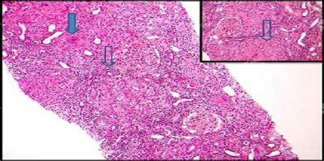 Granulomatous Interstitial Nephritis Due To Renal Limited Sa Saudi