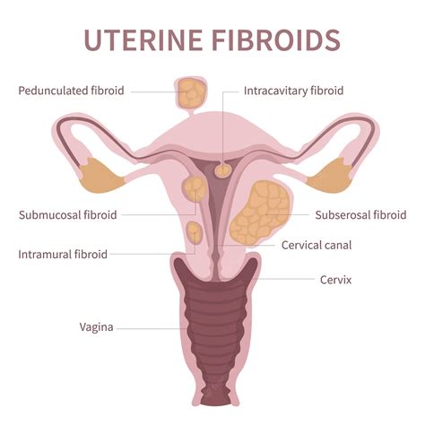 Premium Vector Reproductive System With Uterine Fibroids Myoma