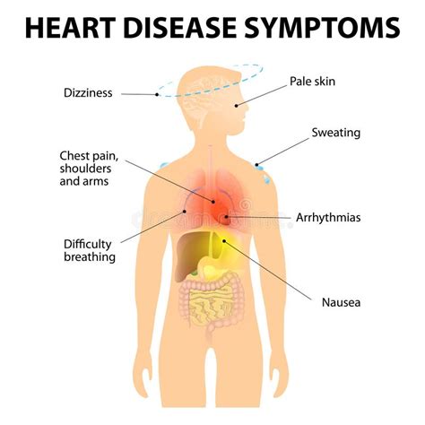 Ischemic Heart Disease Infographics Signs Symptoms And Treatment