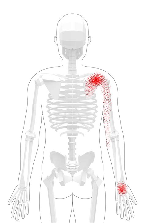 Subscapularis Trigger Points Overview Self Treatment Tips