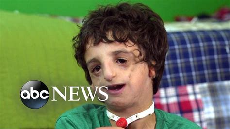 Boy living with Treacher Collins has 53 surgeries by age 11: 20/20 Part 2 - YouTube