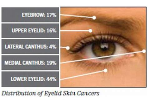 Eyelid Cancer: Diagnosis - The Eyelid Institute