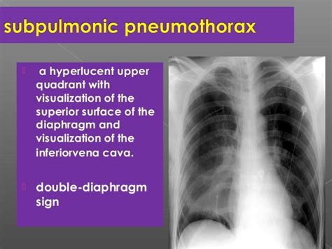 Thoracic Imaging In Critically Ill Patients