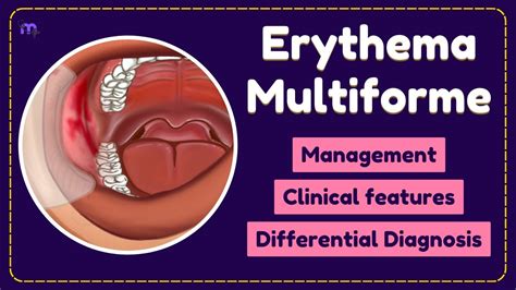 Erythema Multiforme Diagnosis Investigations Management Oral Medicine Animated