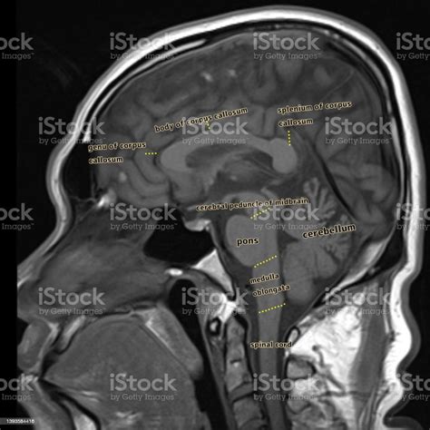 Normal Brain Anatomy Mri Stock Photo Download Image Now Anatomy