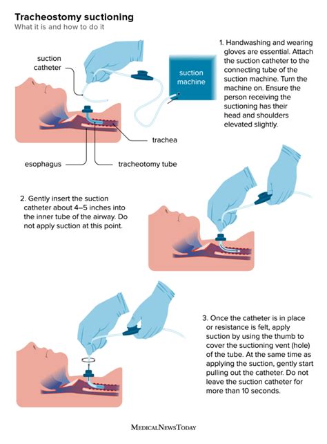 Tracheostomy Suctioning What To Know