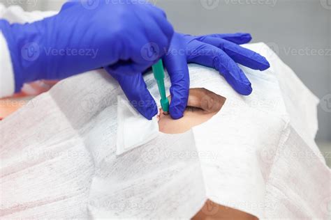 Skin Lesion Removal Procedure Dermatologist Carrying Out A Removal Of