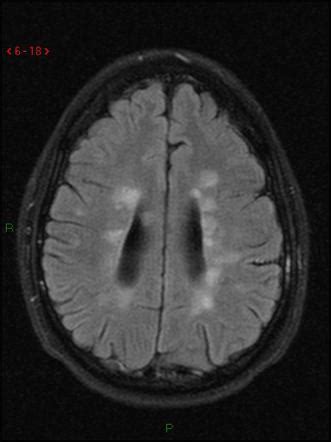 Multiple Sclerosis Mri Dawsons Fingers