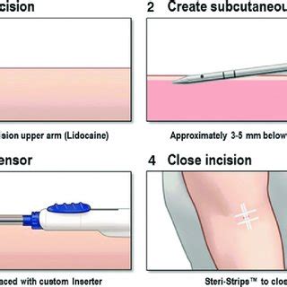 Eversense Sensor CM Centimeter DXA Dexamethasone Acetate PMMA