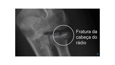 Fratura Da Cabe A Do R Dio O Que Medicina Ortop Dica