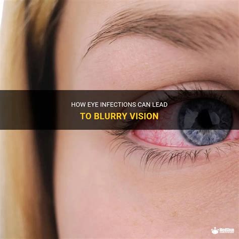 How Eye Infections Can Lead To Blurry Vision Medshun