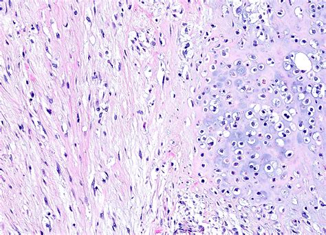 Malignant Phyllodes Tumour With Lymph Node Metastasis A Diagnostic